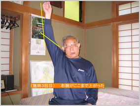 （施術３回目）右肩がここまで上がった