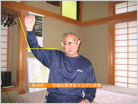（施術前）右肩を限界まで上げた状態